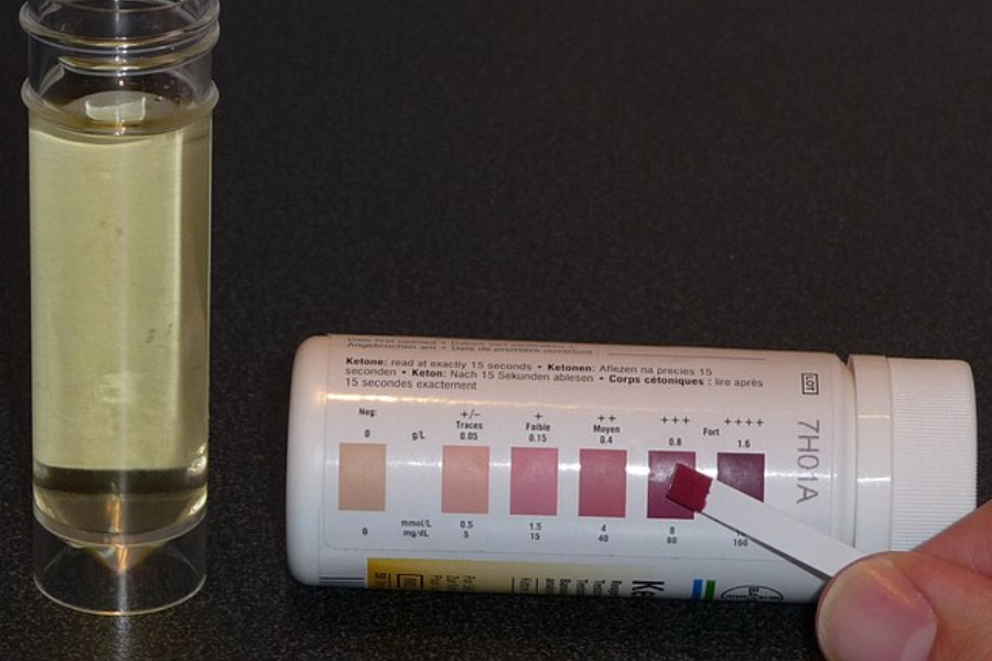 Close-up of a urine sample beside a ketone test strip being compared to a color-coded chart showing ketone levels.
