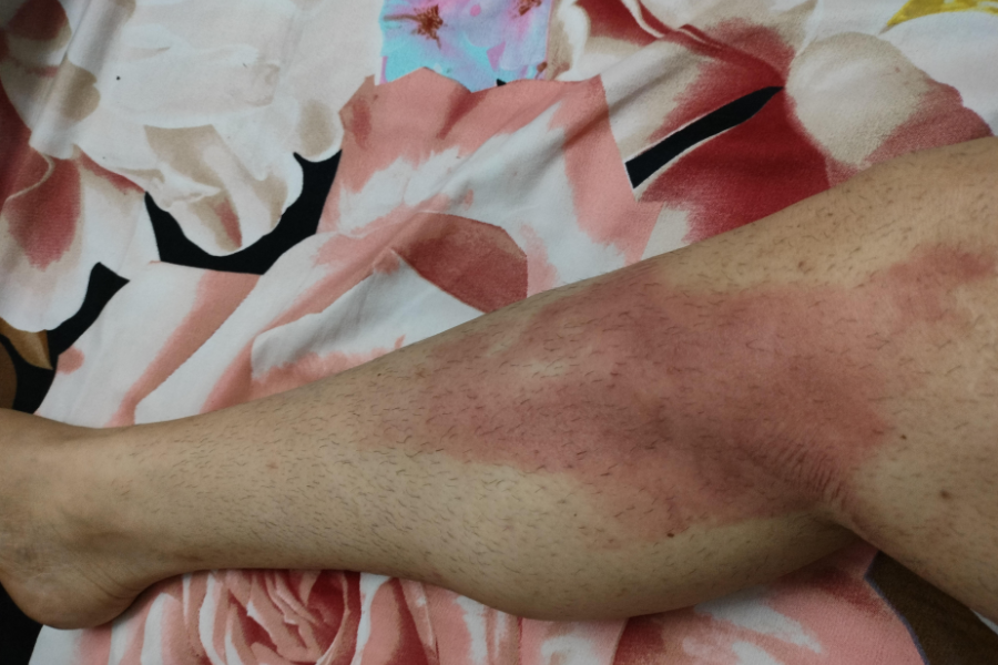 Close-up of a person’s leg with a large red burn mark stretching from the knee to the ankle.