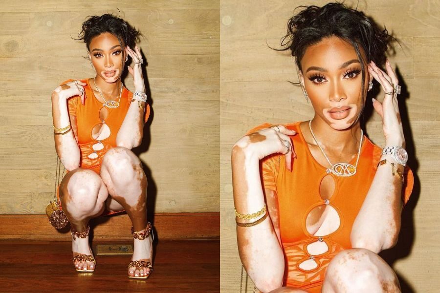 A stylish model with vitiligo wears an orange cut-out mini dress and gold accessories while posing confidently against a wooden wall.