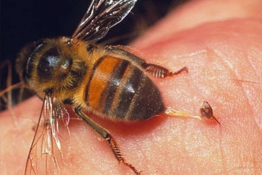 A honeybee stinging human skin, with its stinger embedded and abdomen raised, moments before it pulls away.