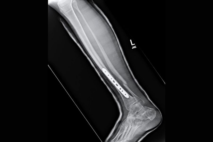 X-ray image of a left leg showing a metal plate with screws along the tibia, indicating surgical repair. Emphasizes medical intervention and healing.